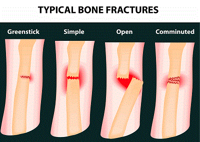 Typical Bone Fractures