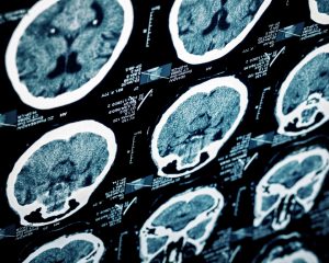 brain injury diagnosis